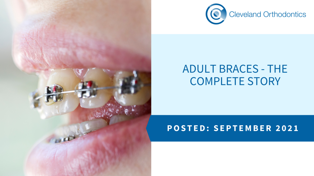 Adult Braces - The Complete Story