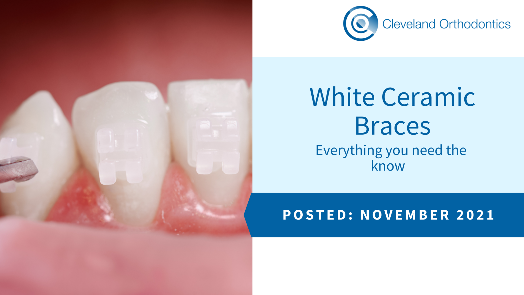 White Ceramic Braces Everything you need the know Cleveland