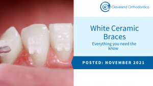 White Ceramic Braces - Everything You Need The Know