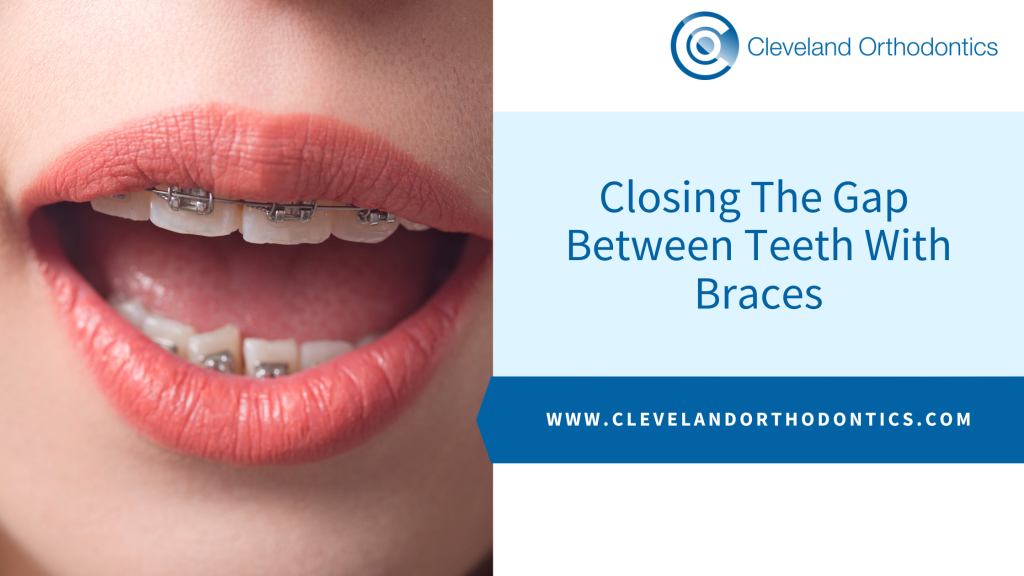 Closing The Gap Between Teeth With Braces