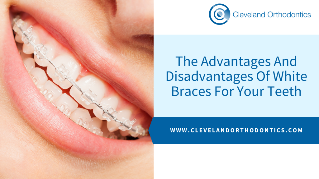 Advantages and Disadvantages of Invisible Braces