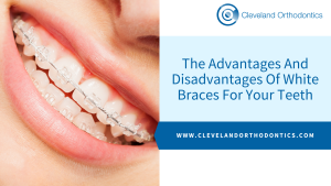 The Advantages And Disadvantages Of White Braces For Your Teeth