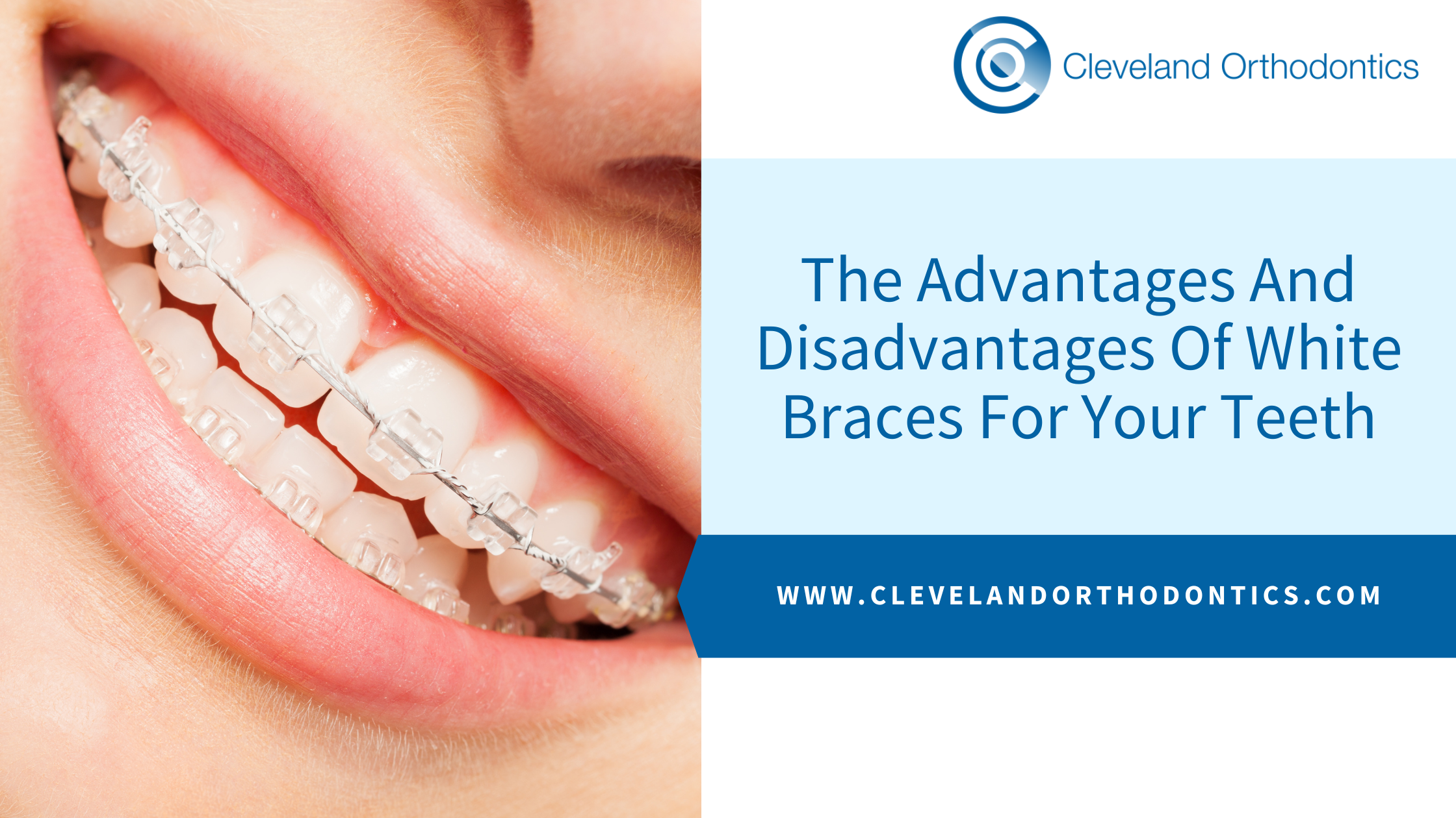 The Advantages And Disadvantages Of White Braces For Your Teeth - Cleveland  Orthodontics in Middlesbrough