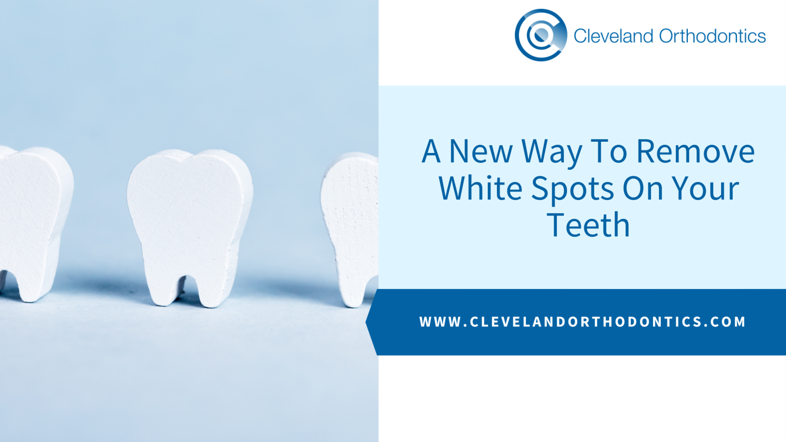 A New Way To Remove White Spots On Your Teeth Cleveland Orthodontics in Middlesbrough