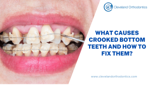 What Causes Crooked Bottom Teeth And How To Fix Them?