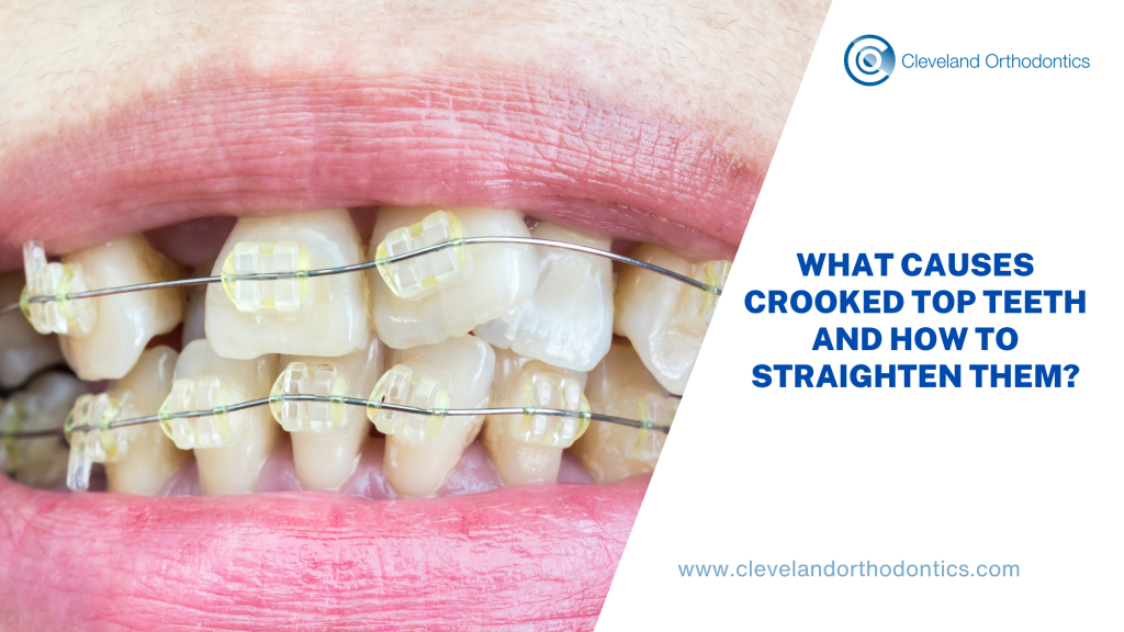 What Causes Crooked Top Teeth And How To Straighten Them?