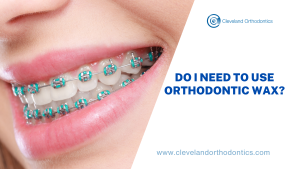 Do I Need To Use Orthodontic Wax?