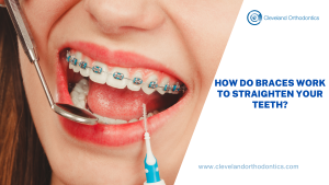 How Do Braces Work To Straighten Your Teeth?