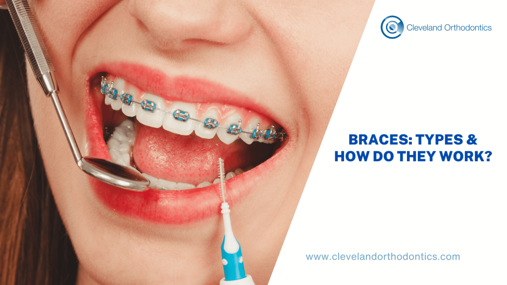 Braces: Types & How Do They Work?