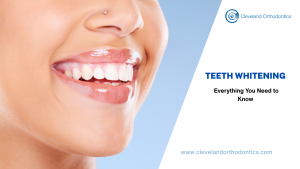Teeth Whitening: Everything You Need To Know